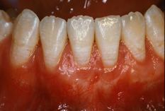 CT Graft After